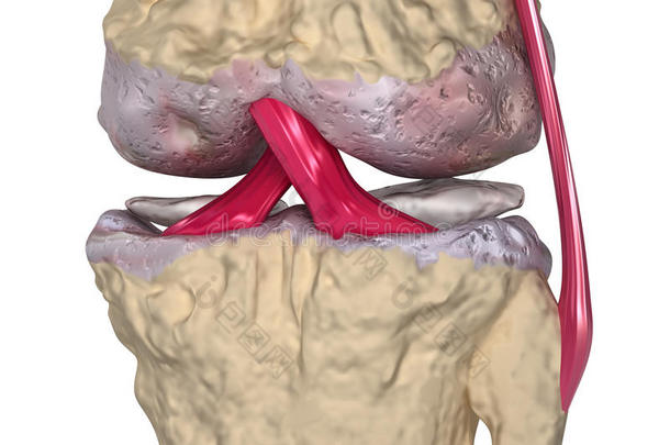 骨关节炎：带韧带的膝关节