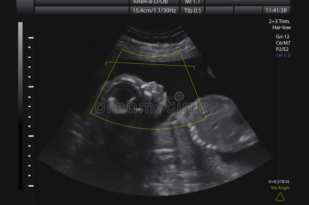 母亲子宫内婴儿的超声波检查。