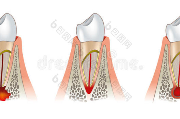 牙齿疾病牙科方案。 牙周炎