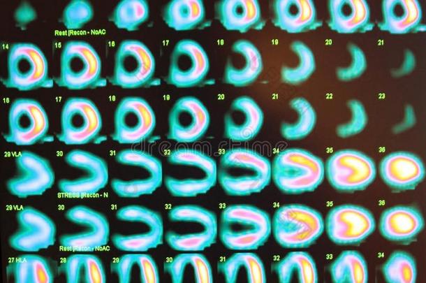 压力测试，核医学
