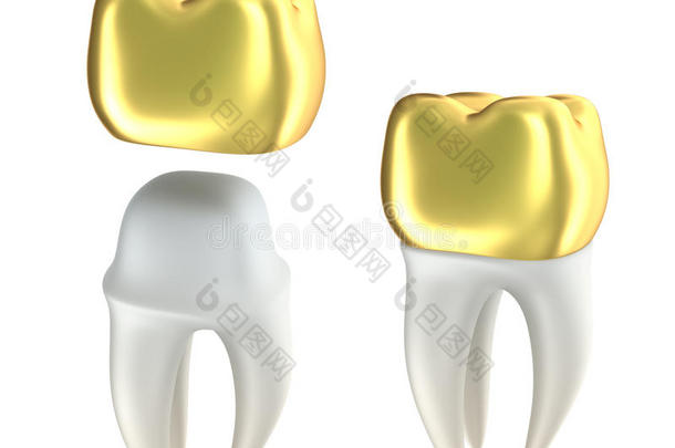 金色牙冠和牙齿