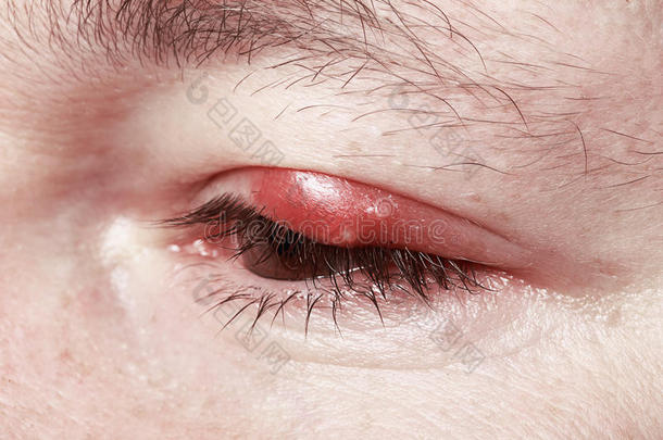 红眼痛。睑缘炎。炎症