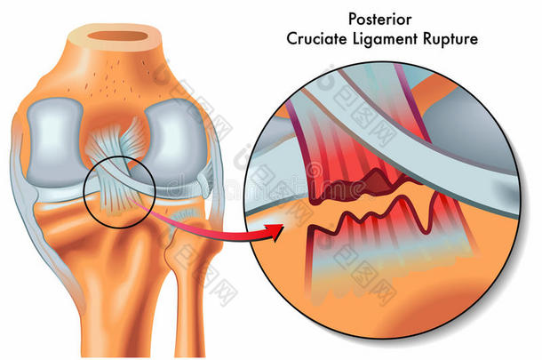 后交叉韧带断裂