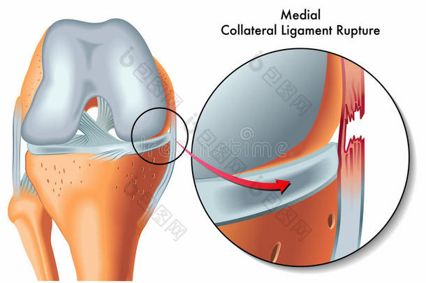 内侧副韧带断裂