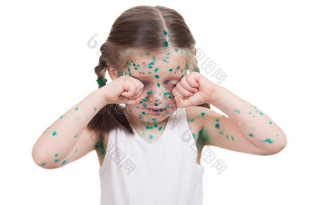 关于孩子的acnes。水痘