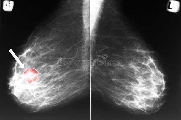 乳腺癌钼靶摄影