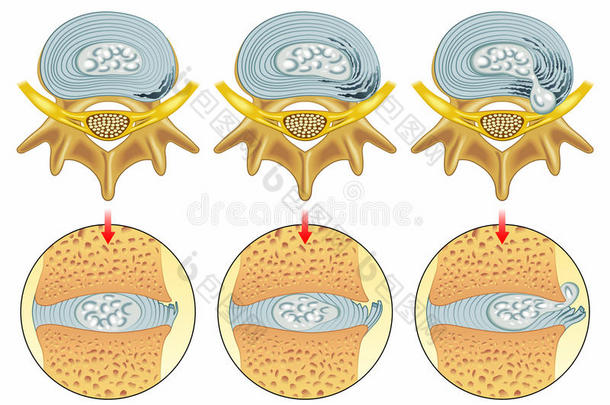 <strong>椎间盘</strong>突出