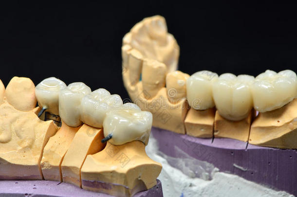带桥种植体的牙齿模型