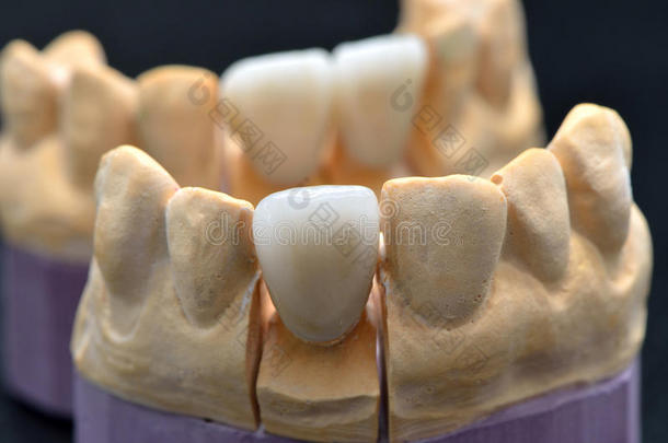假牙模型上的瓷牙