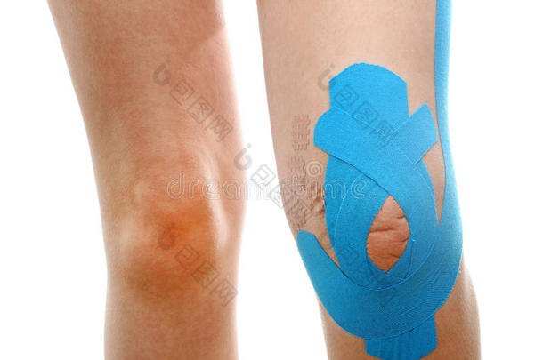 蓝色生理胶带治疗小腿骨折