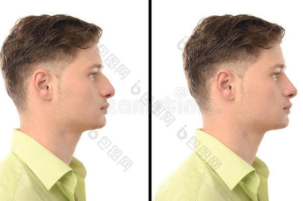 前和后的照片，一个年轻人鼻子手术整形。
