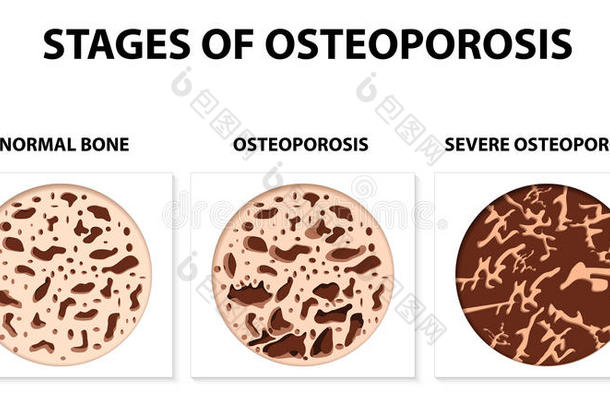 骨质疏松症的分期