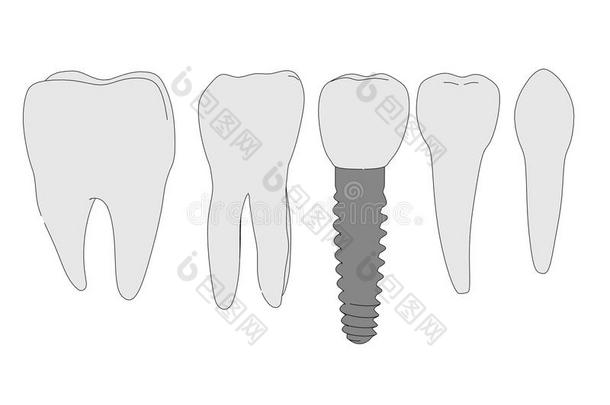 <strong>牙</strong>种植体图像