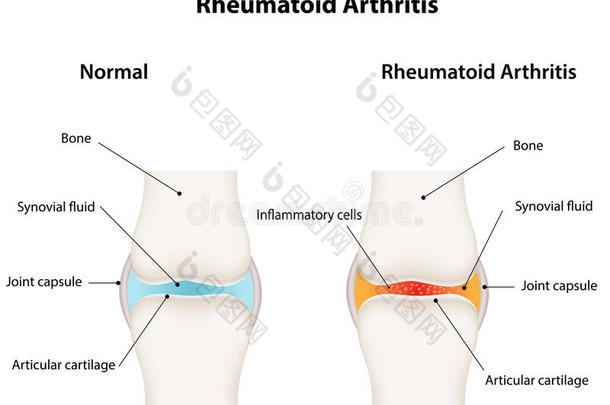 <strong>类风湿关节炎</strong>滑膜关节