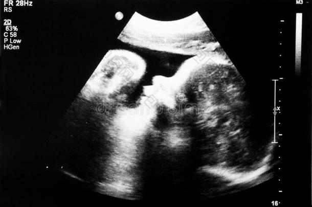 胎儿在子宫内7个月。