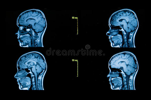 大脑的计算机断层扫描图像