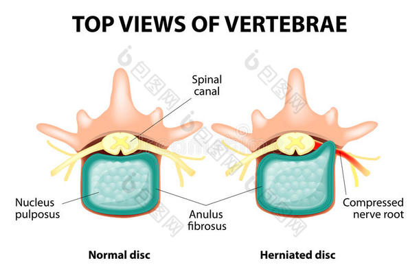 <strong>椎间盘</strong>突出