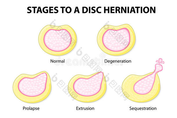 <strong>椎间盘</strong>突出症的分期
