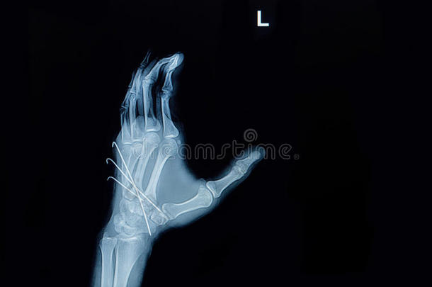 手部骨折x线平片：显示骨折掌骨用k-线（克氏针）嵌插