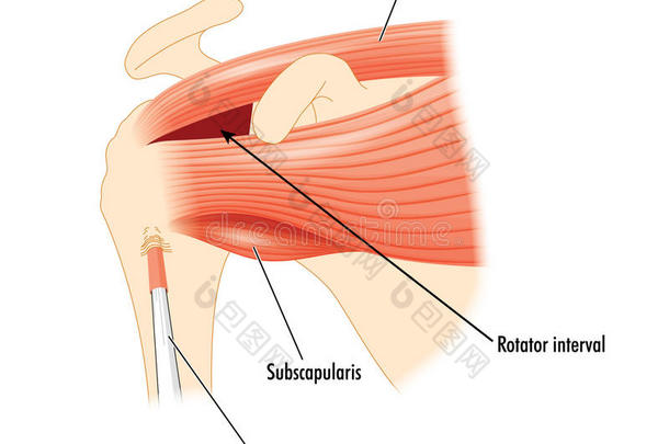 肩袖周围的肩部肌肉