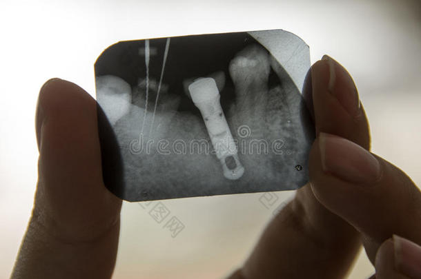 x射线牙齿诊断