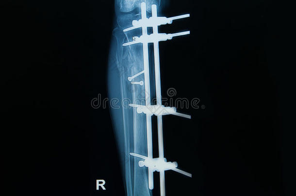 小腿（胫骨）骨折伴植骨x线影像学研究
