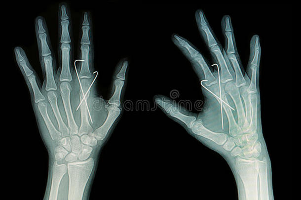 手部骨折x线平片示掌骨骨折