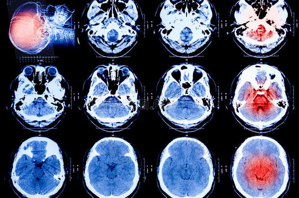 人脑x射线扫描