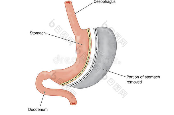 包括切除部分胃的<strong>减肥</strong>手术