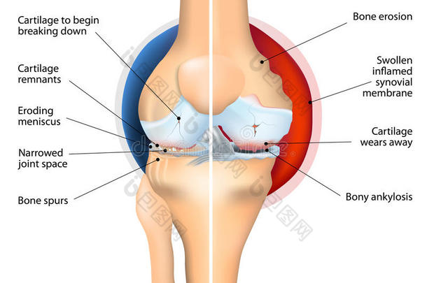 骨<strong>关节炎</strong>与<strong>类风湿关节炎</strong>的比较