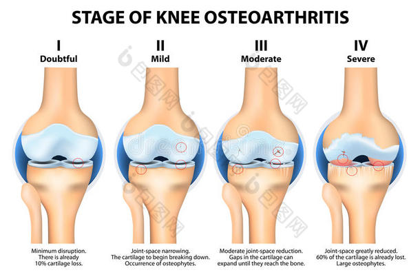 膝<strong>骨关节</strong>炎（oa）的分期。