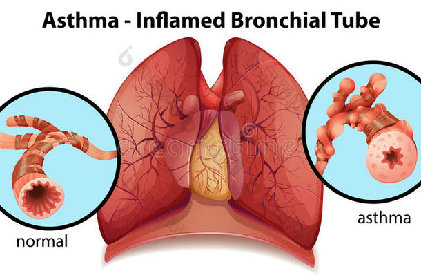 哮喘使支气管发炎