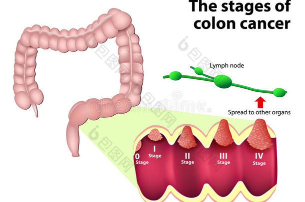 结直肠癌的<strong>分期</strong>