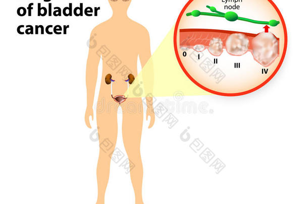 解剖生物学膀胱身体癌症