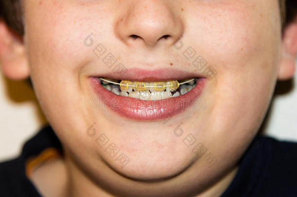 微笑男孩的牙套和洁白的牙齿，<strong>托起</strong>了药