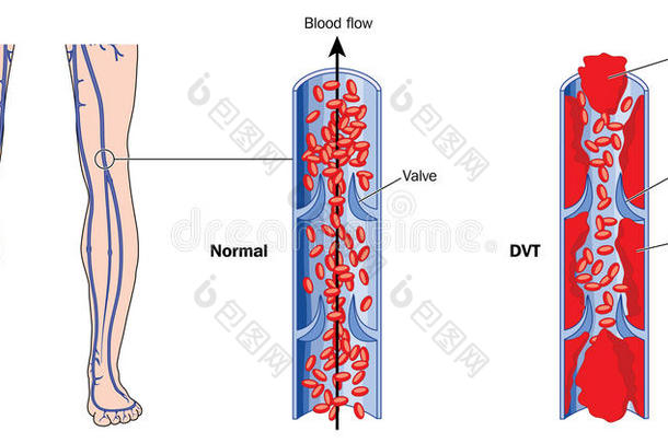 深静脉血栓形成