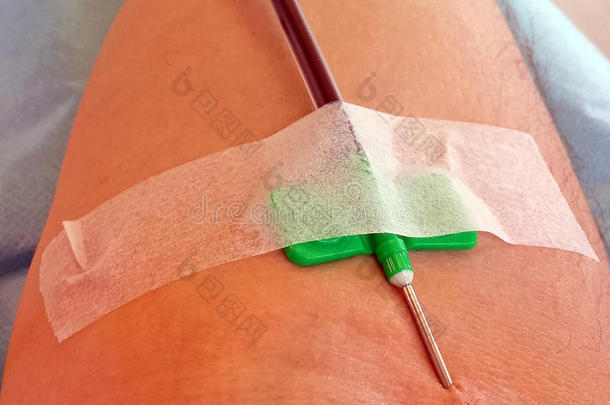 用针头献血