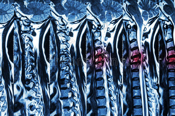 颈椎病合并椎间盘突出(颈椎MRI：显示颈椎病合并椎间盘突出压迫脊柱