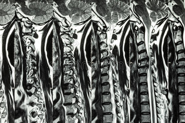 颈椎病合并椎间盘突出(颈椎MRI：显示颈椎病合并椎间盘突出压迫脊柱