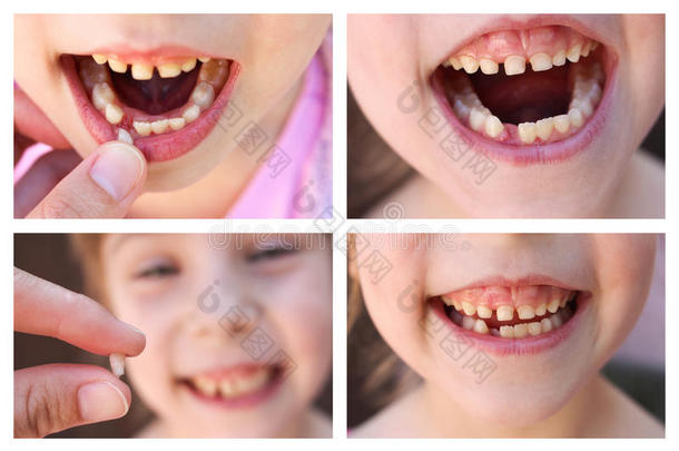 孩子的拼贴<strong>丢失</strong>了婴儿牙。 在6岁的孩子松动牙齿。 那个女孩手里拿着牙齿。