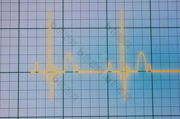 心电图/EKG监视器
