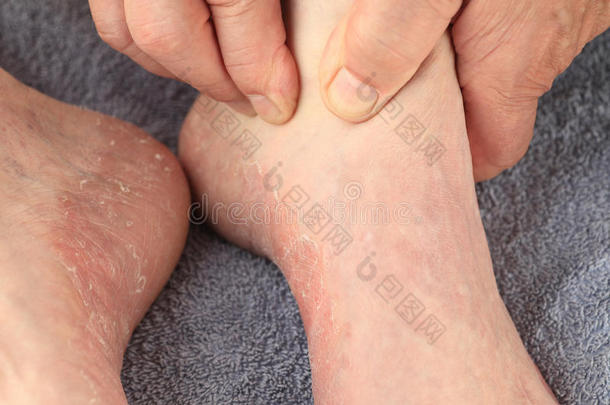 检查运动员足部皮肤干燥的症状