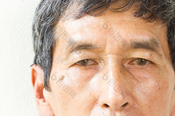 特写亚洲老人的眼睛，他的眼睛是pinguecula。