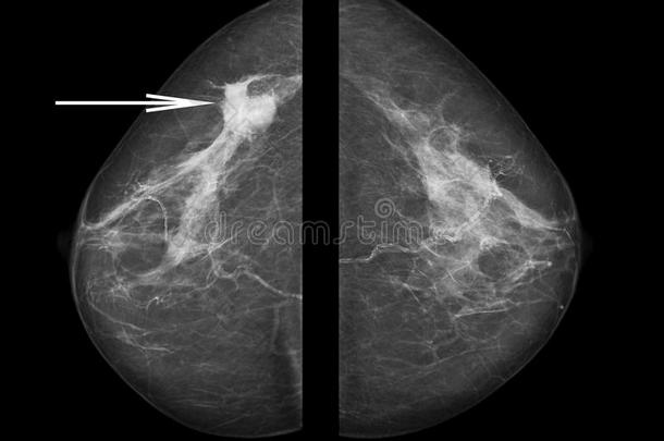 乳腺癌。 乳房X线照片。