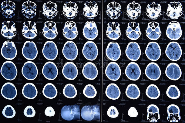 大脑的计算机断层扫描图像