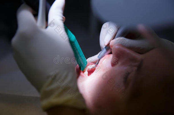 微积分清洁的刮匙牙科牙医