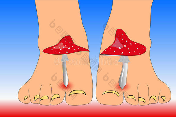 蘑菇在脚趾脚之间模仿脚趾<strong>真菌</strong>