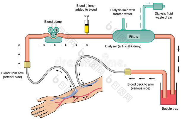 肾透析机示意图