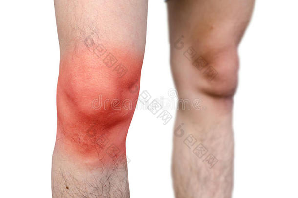 男人膝盖的剧烈疼痛。 在白色背景上。