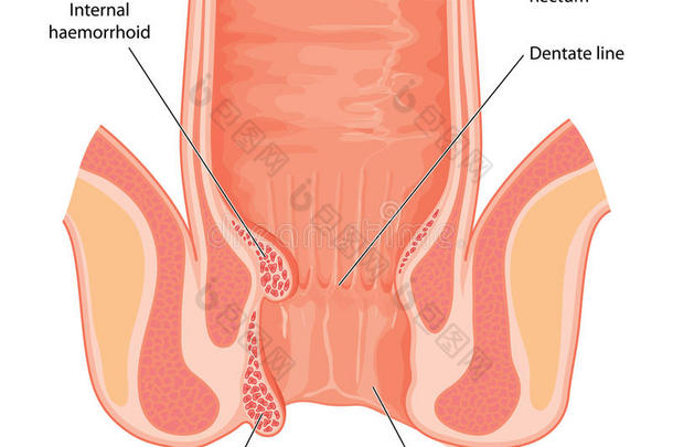 <strong>痔疮</strong>显示在肛管横截面